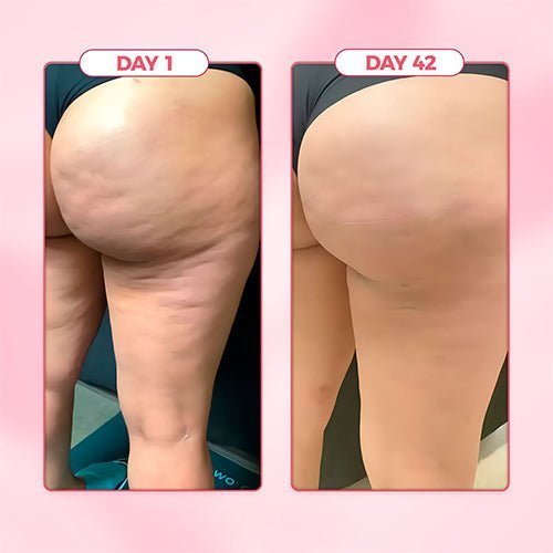 Cellulite Relief Kit